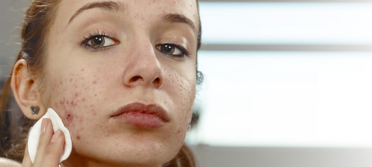 Polycystic ovarian syndrome acne treatment