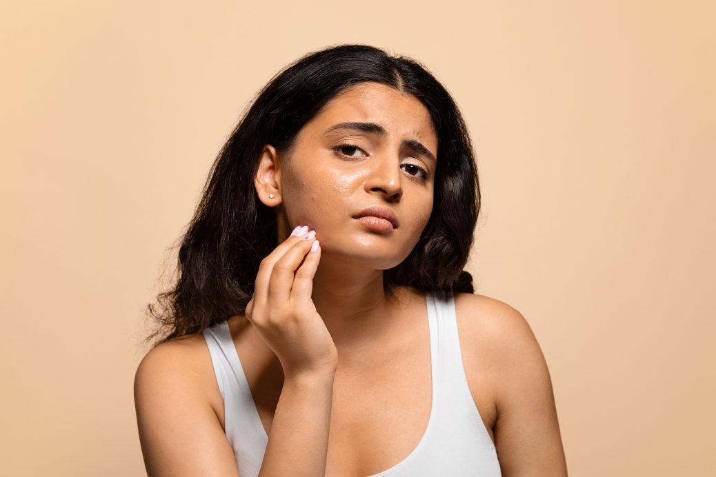 Woman experiencing acne and skin issues related to PCOS